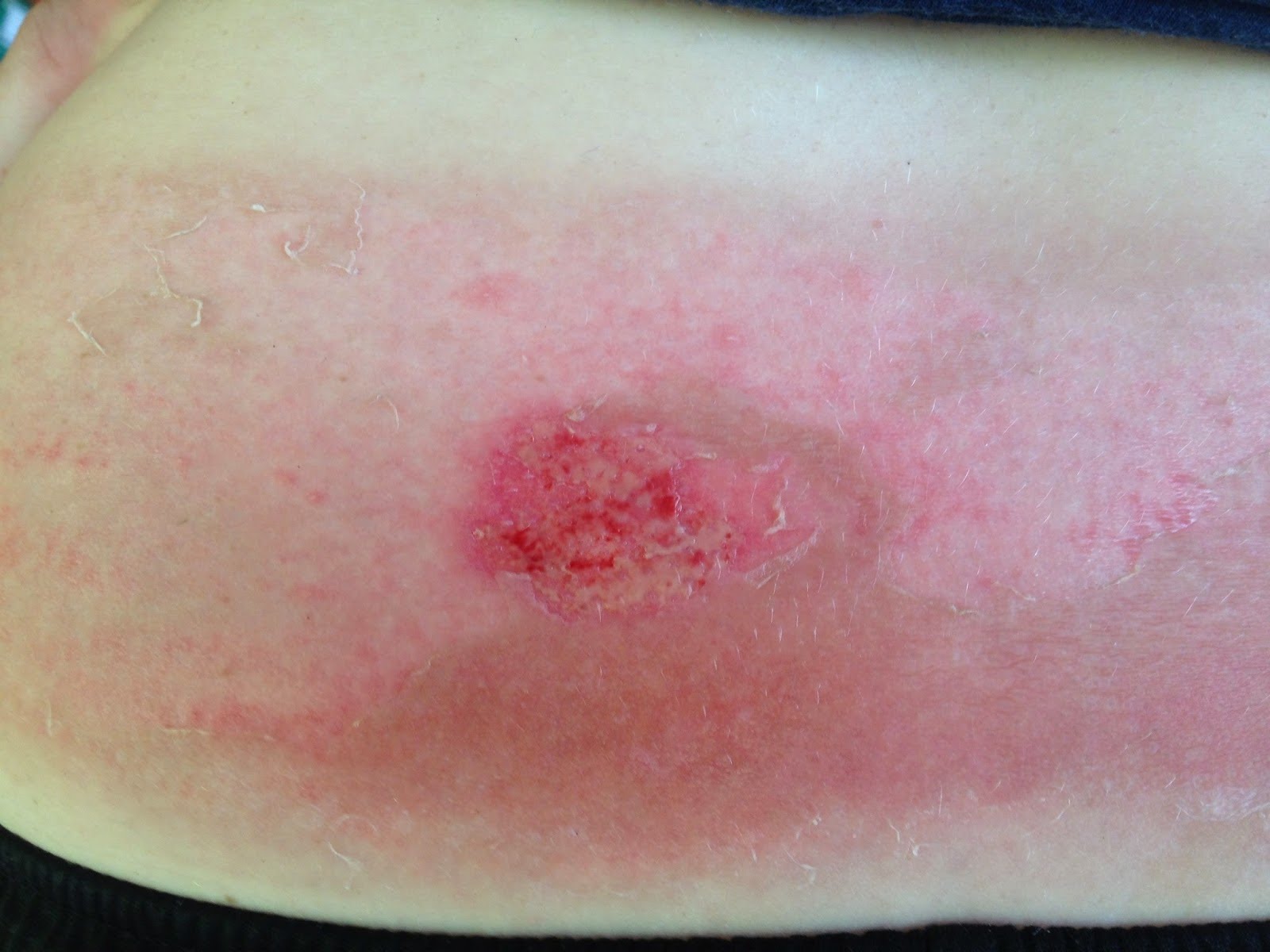 Notkun sýklalyfja í landbúnaði tifandi tímasprengja