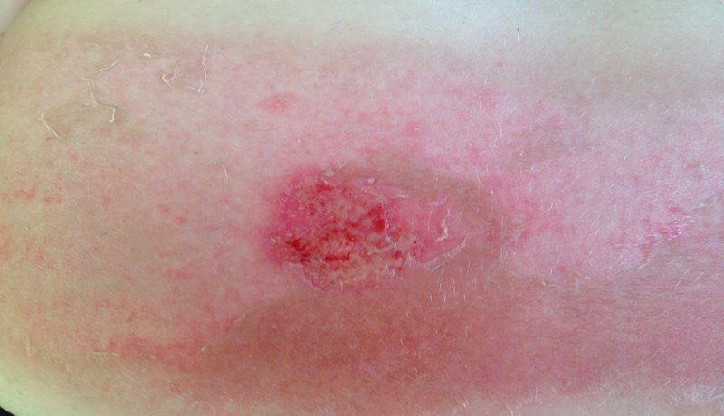 Notkun sýklalyfja í landbúnaði tifandi tímasprengja